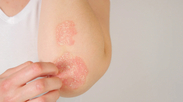 Understanding Psoriasis: A Clear Guide to Skin Health
