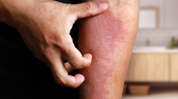 Eczema 101: What it is and How to Treat It