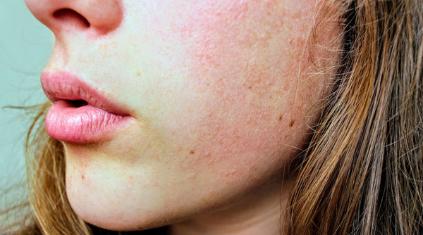 Rosacea: Yes, Your Skin Can Heal. Here’s How.