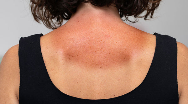 Summer Sun Got You Seeing Spots? Here’s Three Skincare Dos & Don’ts.
